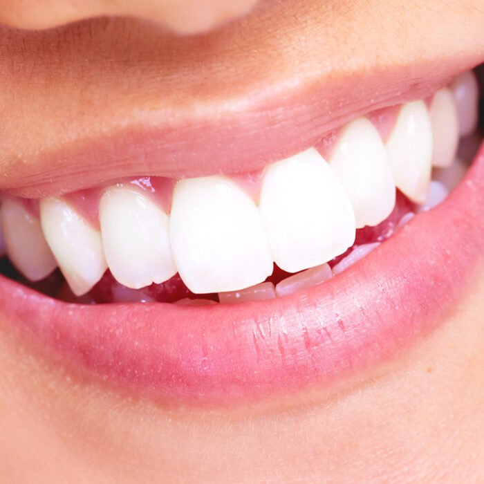 Strahlend weisse Zähne mit Zahnbleaching