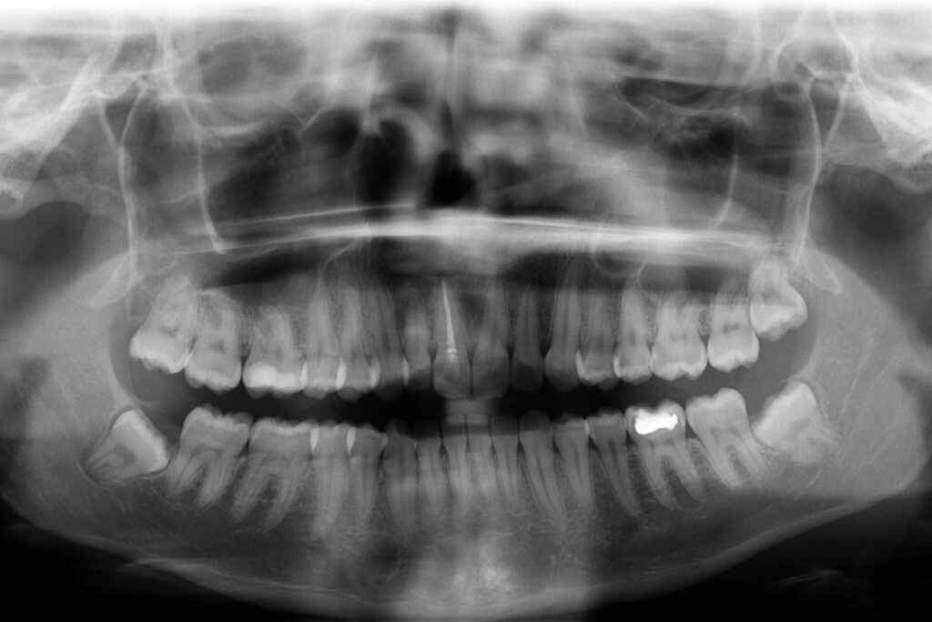 Das Panoramabild der Zähne