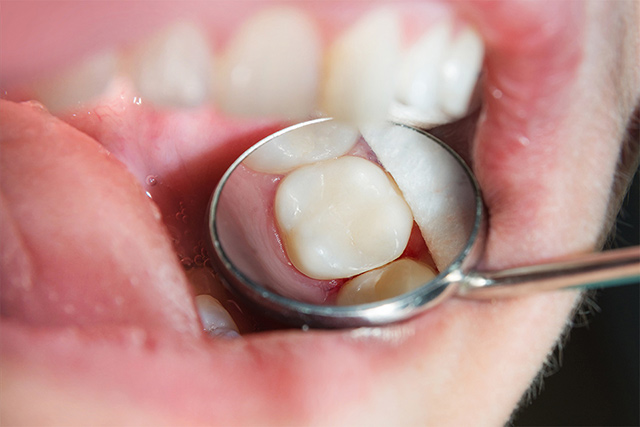 Menschliche Zähne in Nahaufnahme während der Restauration einer Füllung.