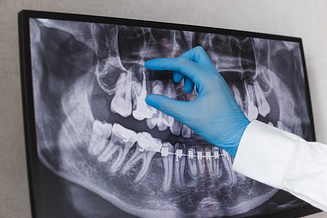 Arzt zeigt auf gefüllten Wurzelkanal im Zahnröntgenbild