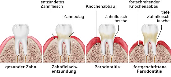 Die Stadien der Paradontitis