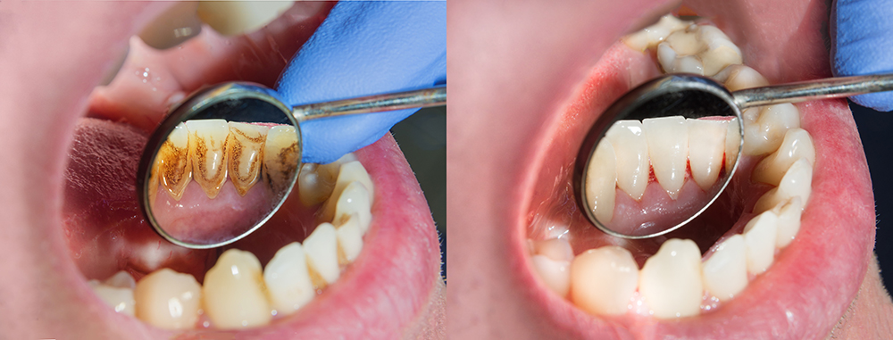 Die Zahnreinigung wirkt vorbeugend und gehört zum Gesundheitsbewusstsein.